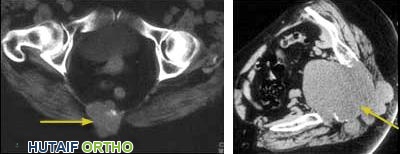 فحوصات الأشعة المقطعية تظهر الأورام الحبلية